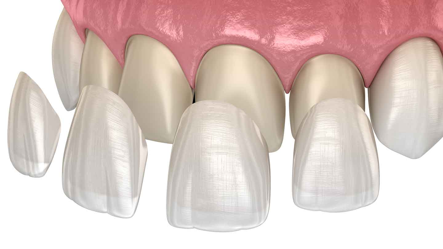 E-max Veneer